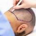Hair Transplant Turkey Cost – Beware Of Misleading Costs